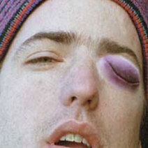 Unbranded SWOLLEN EYE